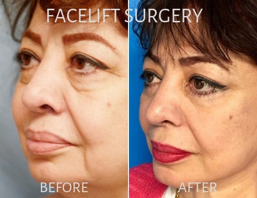 Woman before and after Facelift surgery