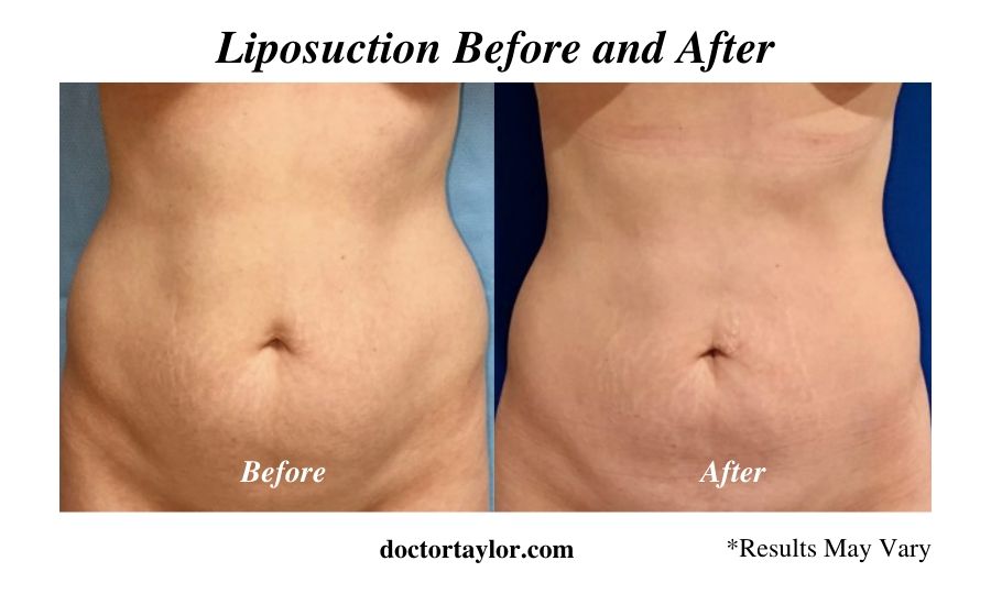 A woman before and after her liposuction treatment in Los Angeles to tighten her midsection area.