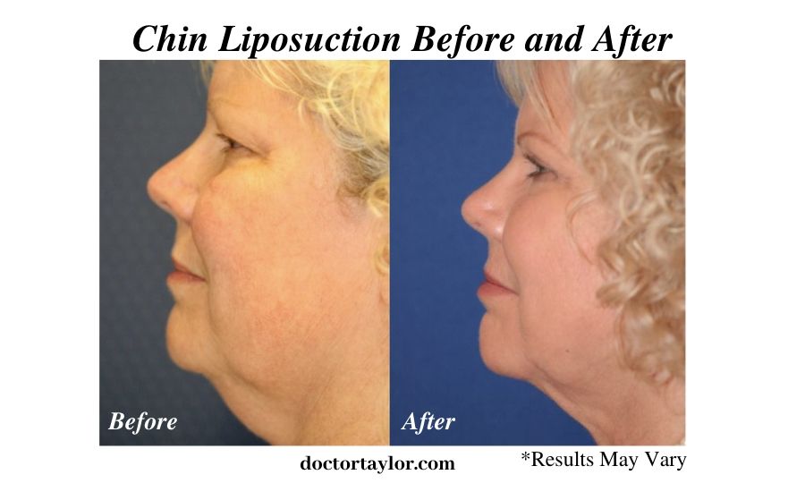 A woman before and after her chin liposuction procedure in Los Angeles. The results are after a four month time span.