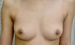 Breast Augmentation 19 Before