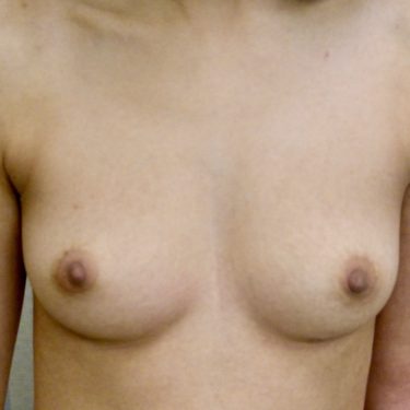 Breast Augmentation 19 Before 1