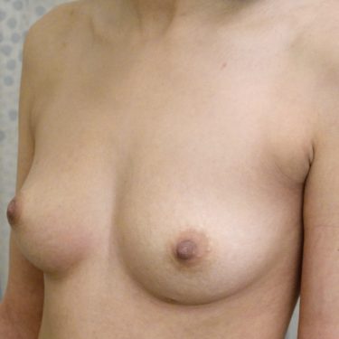 Breast Augmentation 19 Before 2