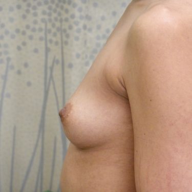 Breast Augmentation 19 Before 3