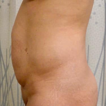 BodyTite 02 Before 2