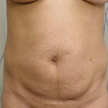 BodyTite 02 Before 1