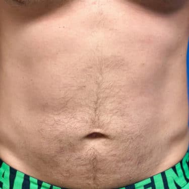 BodyTite 01 Before 1