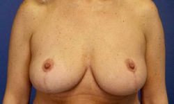 BREAST IMPLANT REMOVAL 02 After