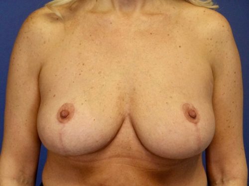 BREAST IMPLANT REMOVAL 02 After 1