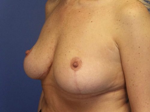 BREAST IMPLANT REMOVAL 02 After 2