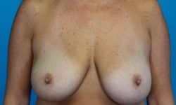 BREAST IMPLANT REMOVAL 02 Before