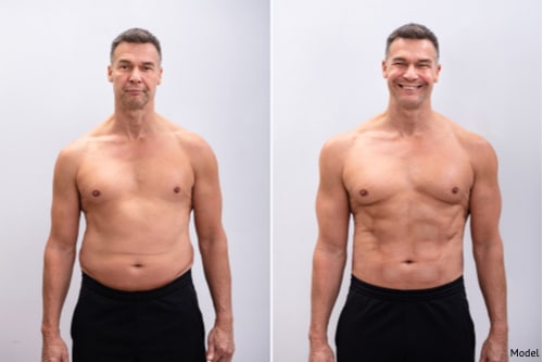 Man showing off the effects of tightened skin and reduced fat.