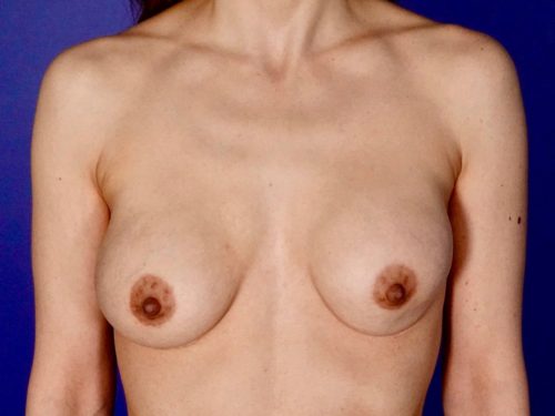 Breast Implant Exchange 08 Before 1