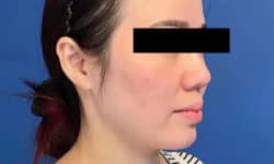 Morpheus8 Patient 02 Before