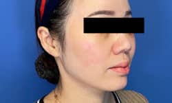 Morpheus8 Patient 02 After