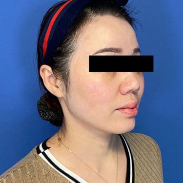 Morpheus8 Patient 02 After 1