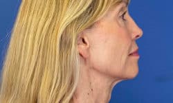 Morpheus8 Patient 03 After