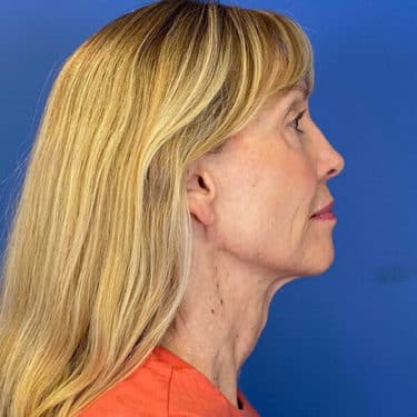 Morpheus8 Patient 03 After 1