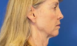 Morpheus8 Patient 03 Before