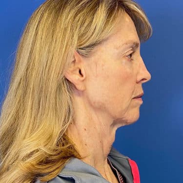 Morpheus8 Patient 03 Before 1