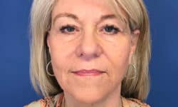 Morpheus8 Patient 01 After