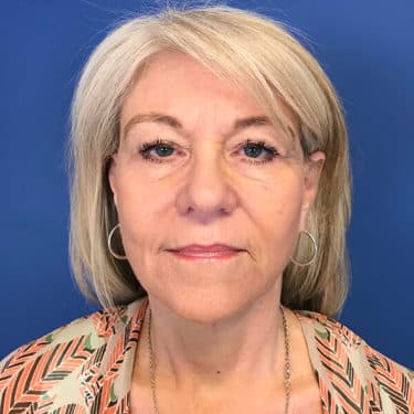 Morpheus8 Patient 01 After 1