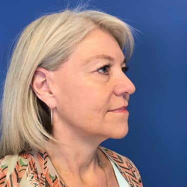 Morpheus8 Patient 01 After 2