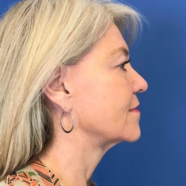 Morpheus8 Patient 01 After 3