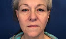 Morpheus8 Patient 01 Before