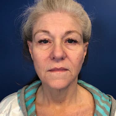 Morpheus8 Patient 01 Before 1