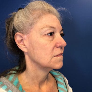 Morpheus8 Patient 01 Before 2