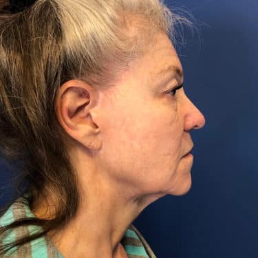 Morpheus8 Patient 01 Before 3