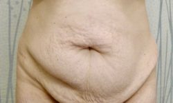 Tummy Tuck 15 Before