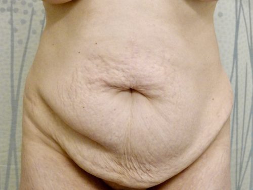 Tummy Tuck 15 Before 1