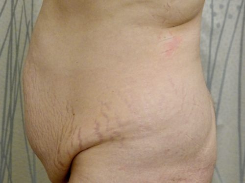 Tummy Tuck 15 Before 2