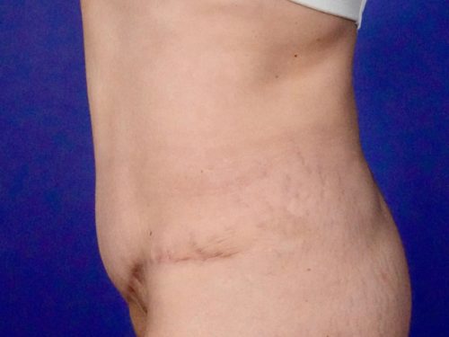Tummy Tuck 15 After 2