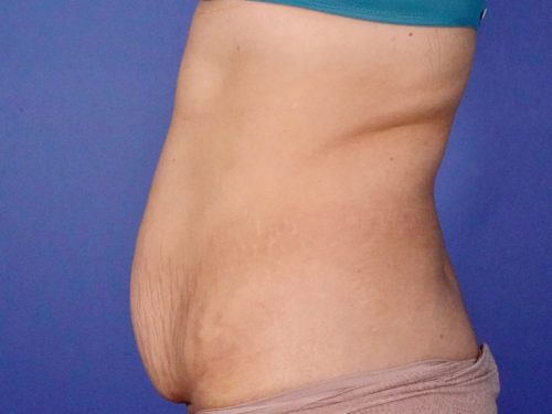 BodyTite 03 Before 2