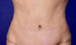 Tummy Tuck 15 After