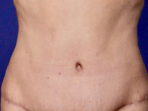Tummy Tuck 15 After 1