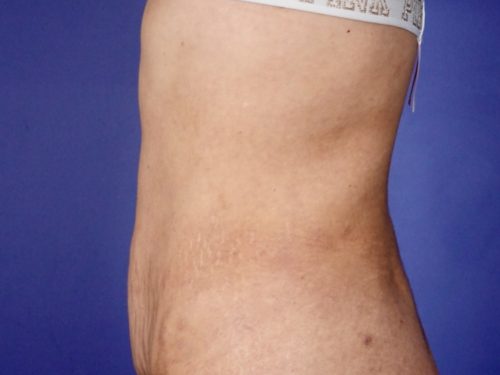BodyTite 03 After 2