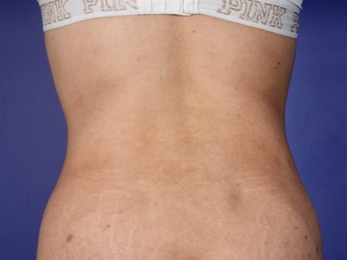 BodyTite 03 After 3