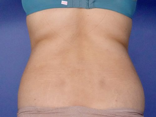 BodyTite 03 Before 3