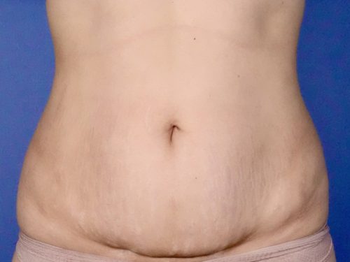 BodyTite 03 Before 1