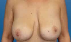 BREAST IMPLANT EXCHANGE AND BREAST LIFT 05 Before