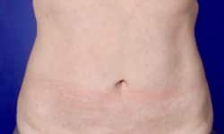 Liposuction 10 After