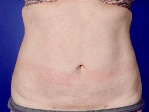 Liposuction 10 After 1