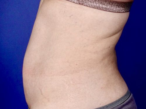 Liposuction 10 After 2