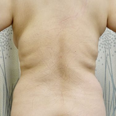 BodyTite 04 Before 1