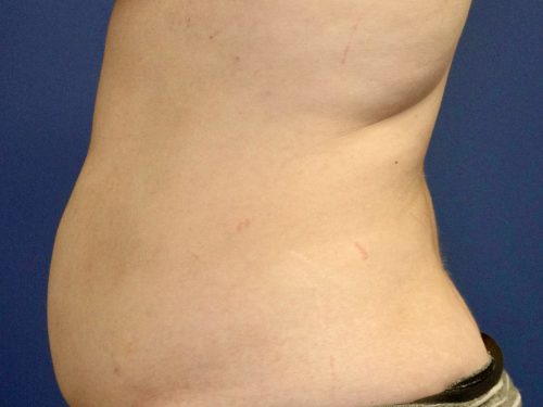 Liposuction 10 Before 2