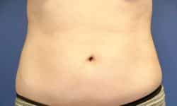 Liposuction 10 Before