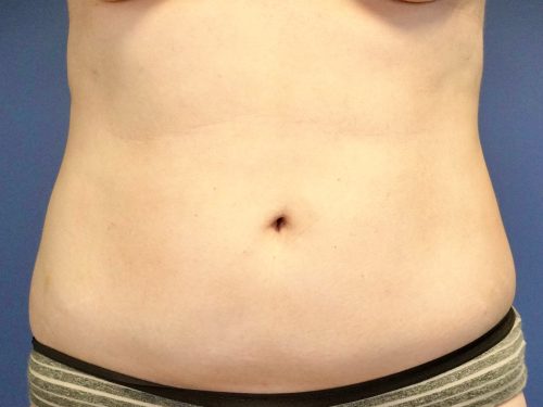 Liposuction 10 Before 1